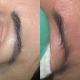 Laserowe usuwanie makijażu permanentnego brwi zaraz po zabiegu za pomocą lasera NDYAG Boroń Permanentne Piękno