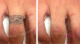 Laserowe usuwanie tatuażu za pomoca lasera NDYAG Boroń Permanentne Piękno